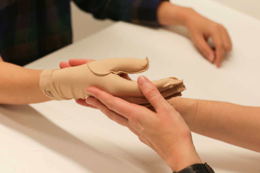 A compression glove being fitted for oedema management